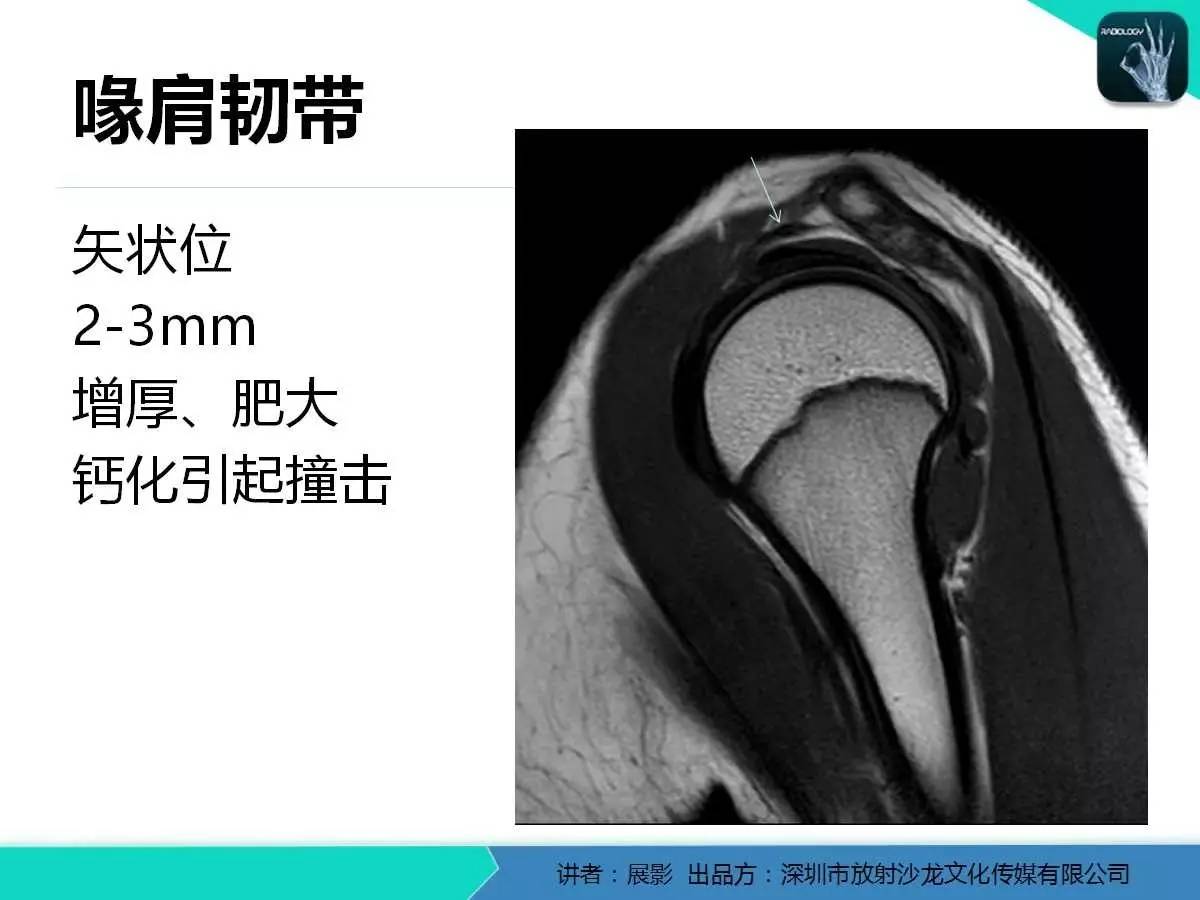 肩峰下撞击综合征和肩袖损伤的MR表现