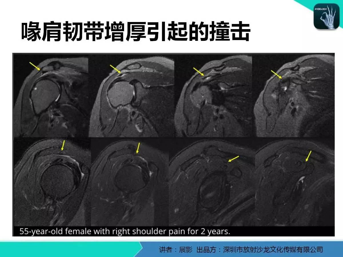 肩峰下撞击综合征和肩袖损伤的MR表现