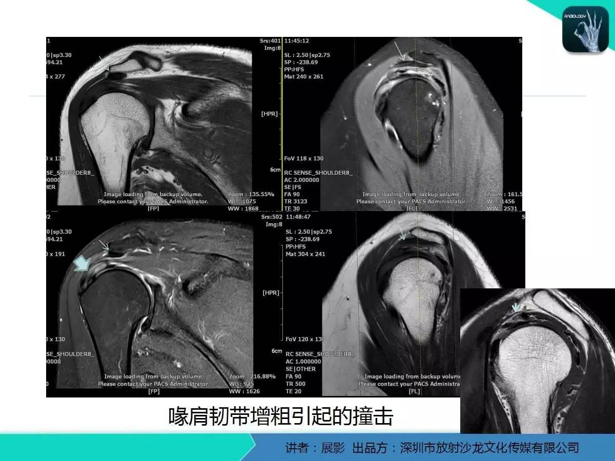 肩峰下撞击综合征和肩袖损伤的MR表现