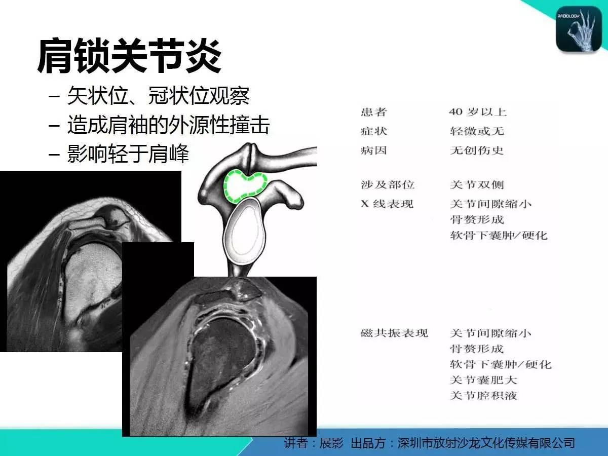 肩峰下撞击综合征和肩袖损伤的MR表现