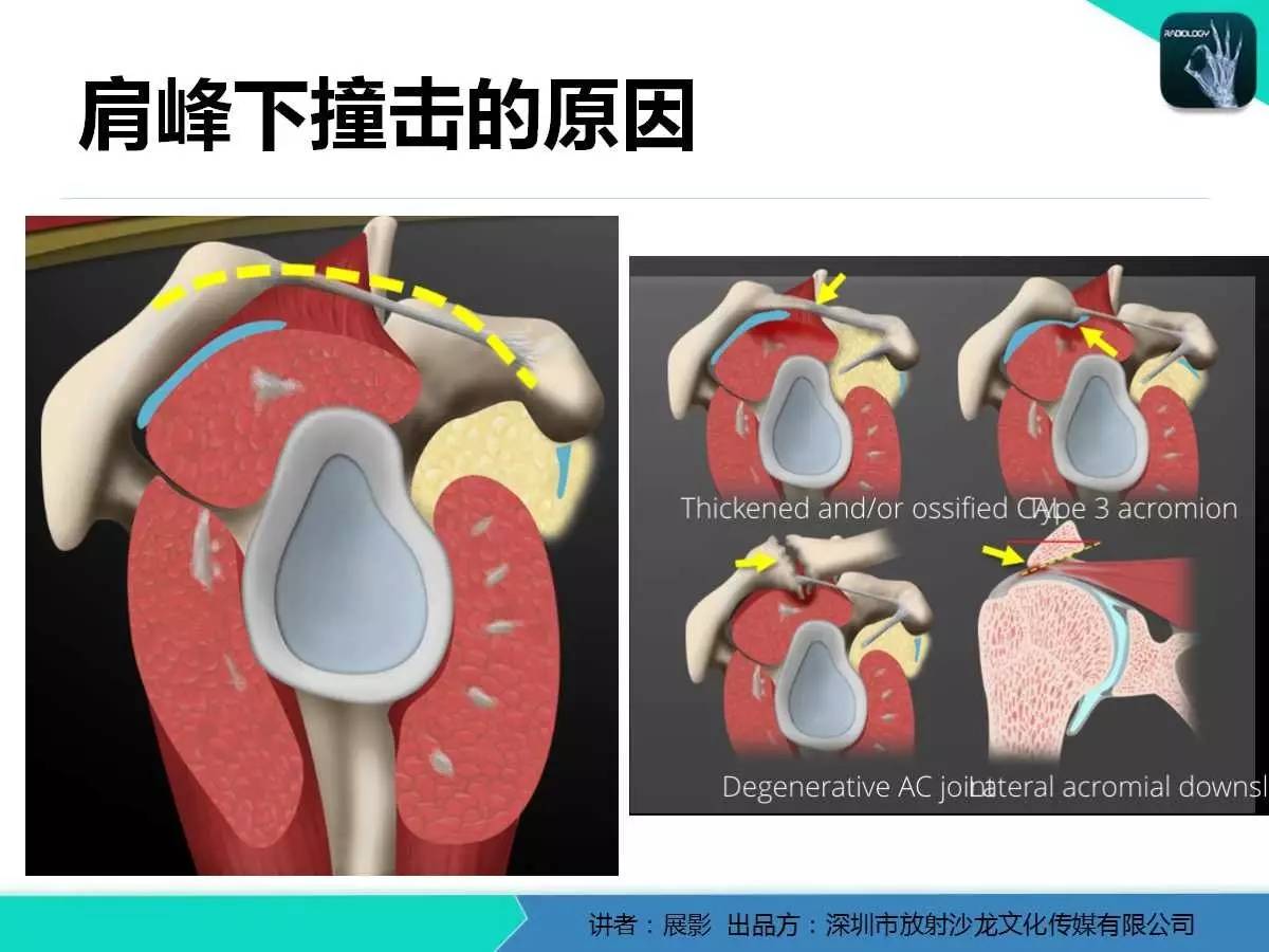 肩峰下撞击综合征和肩袖损伤的MR表现