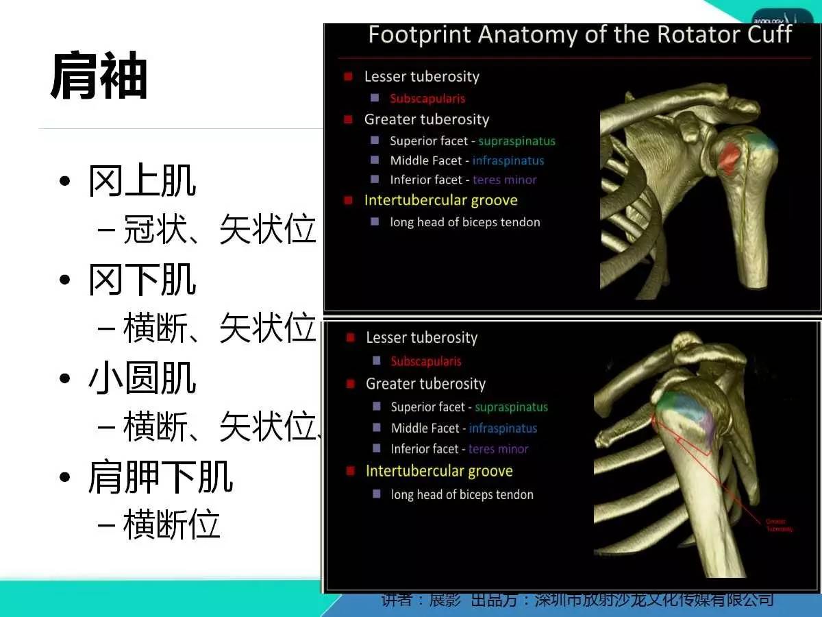 肩峰下撞击综合征和肩袖损伤的MR表现