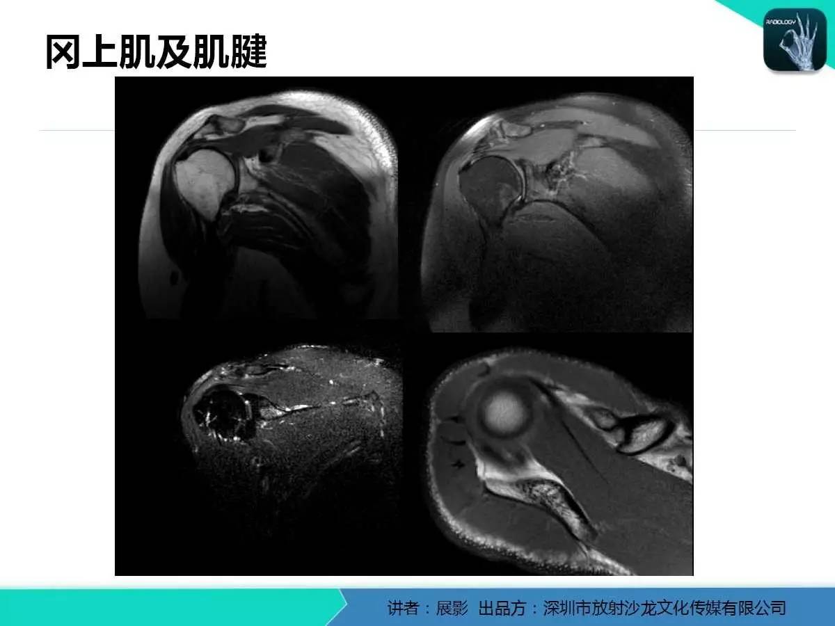 肩峰下撞击综合征和肩袖损伤的MR表现