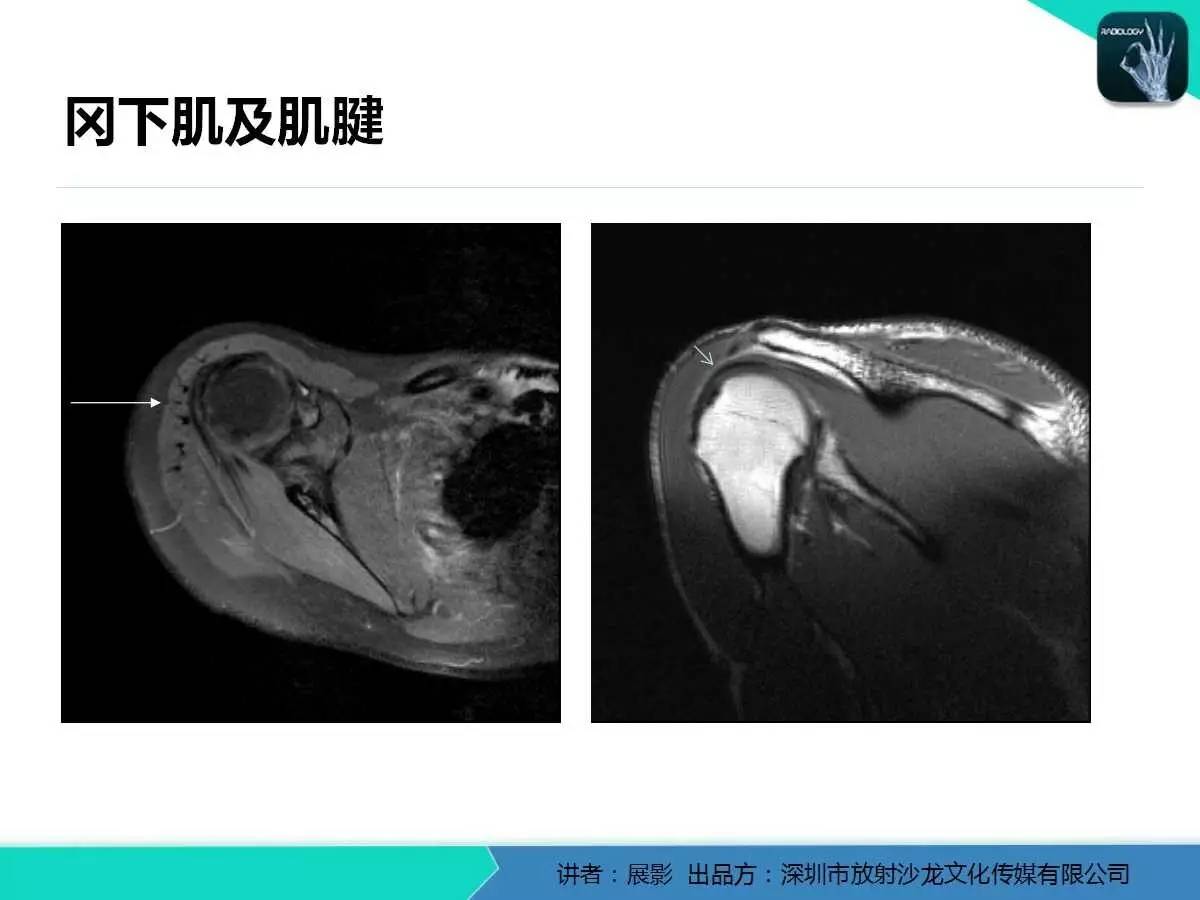 肩峰下撞击综合征和肩袖损伤的MR表现