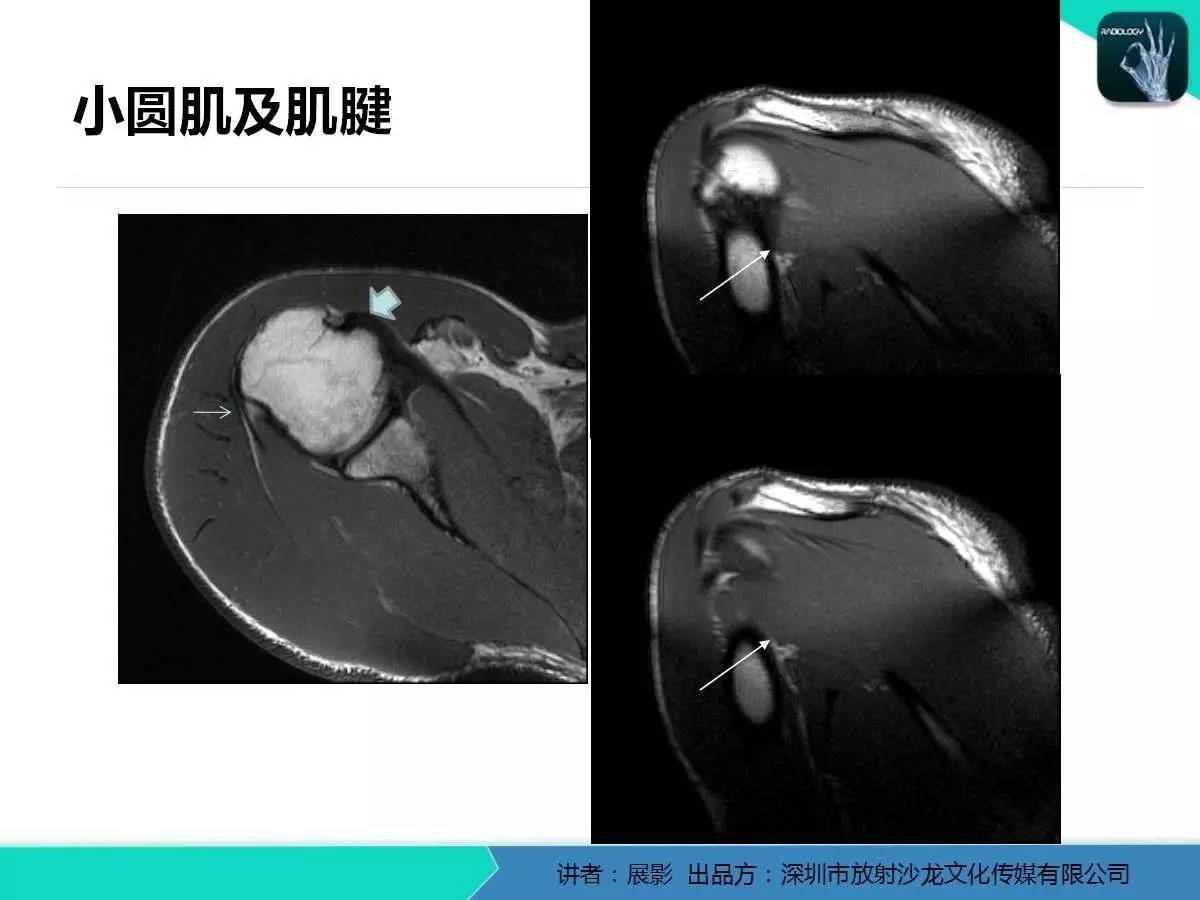 肩峰下撞击综合征和肩袖损伤的MR表现