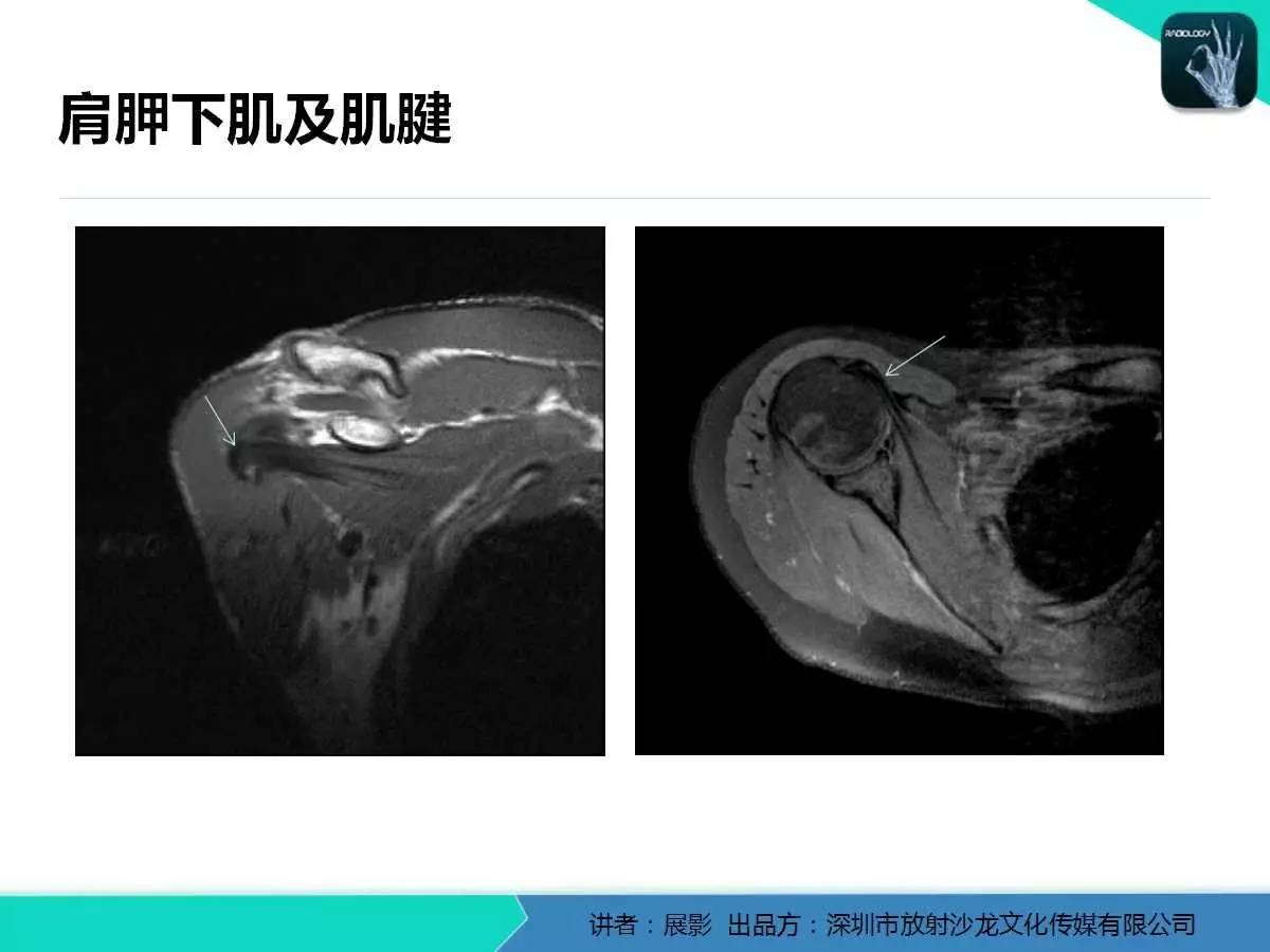 肩峰下撞击综合征和肩袖损伤的MR表现