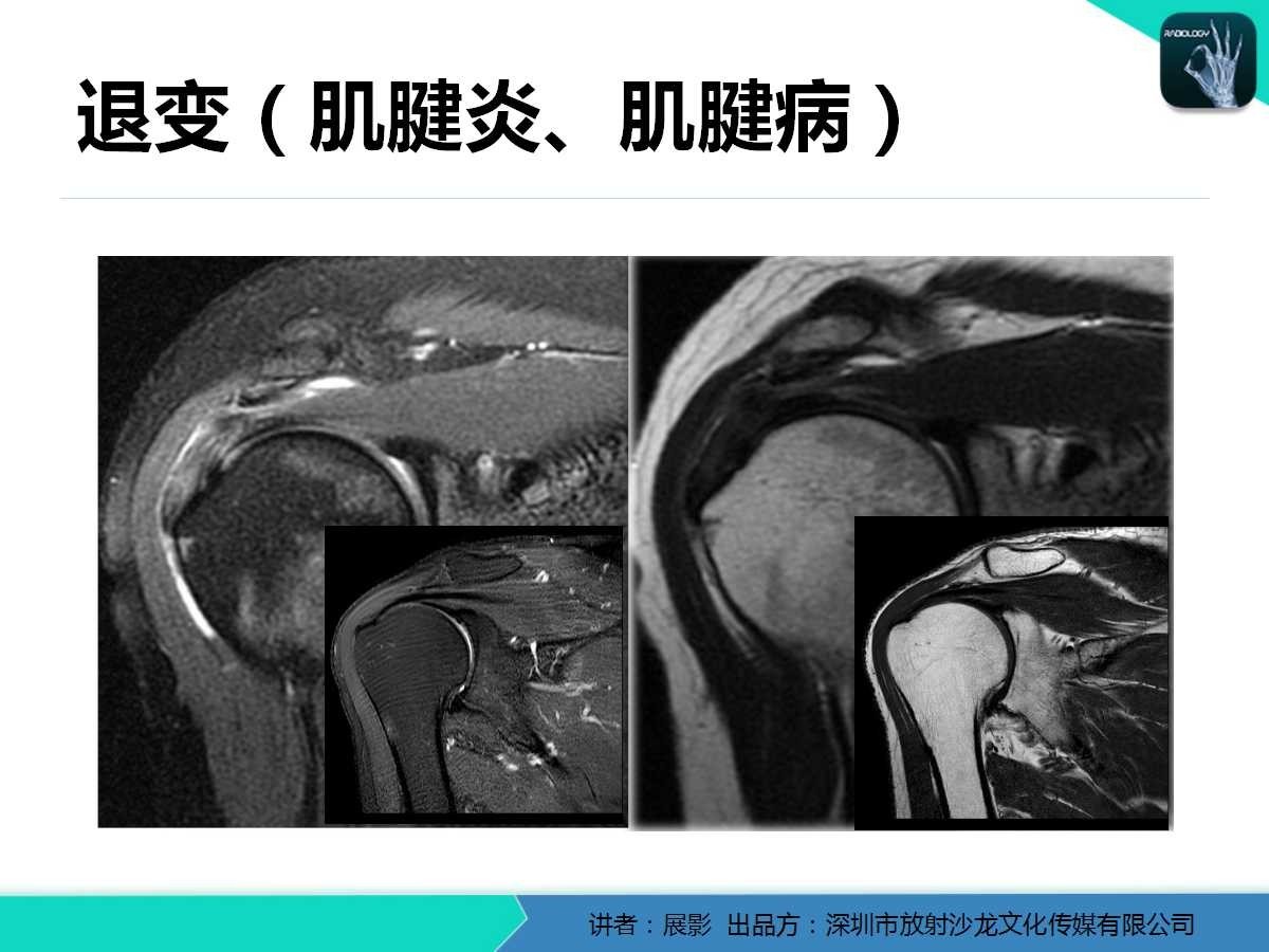 肩峰下撞击综合征和肩袖损伤的MR表现