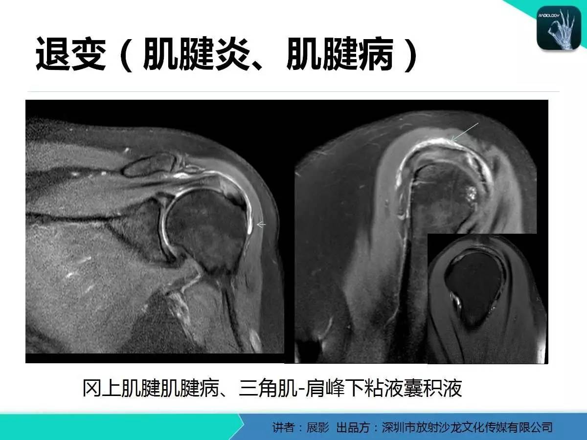 肩峰下撞击综合征和肩袖损伤的MR表现