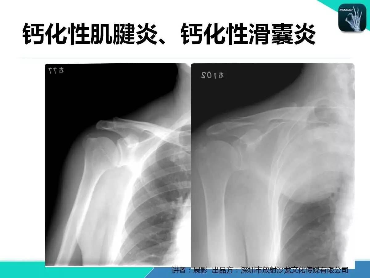 肩峰下撞击综合征和肩袖损伤的MR表现