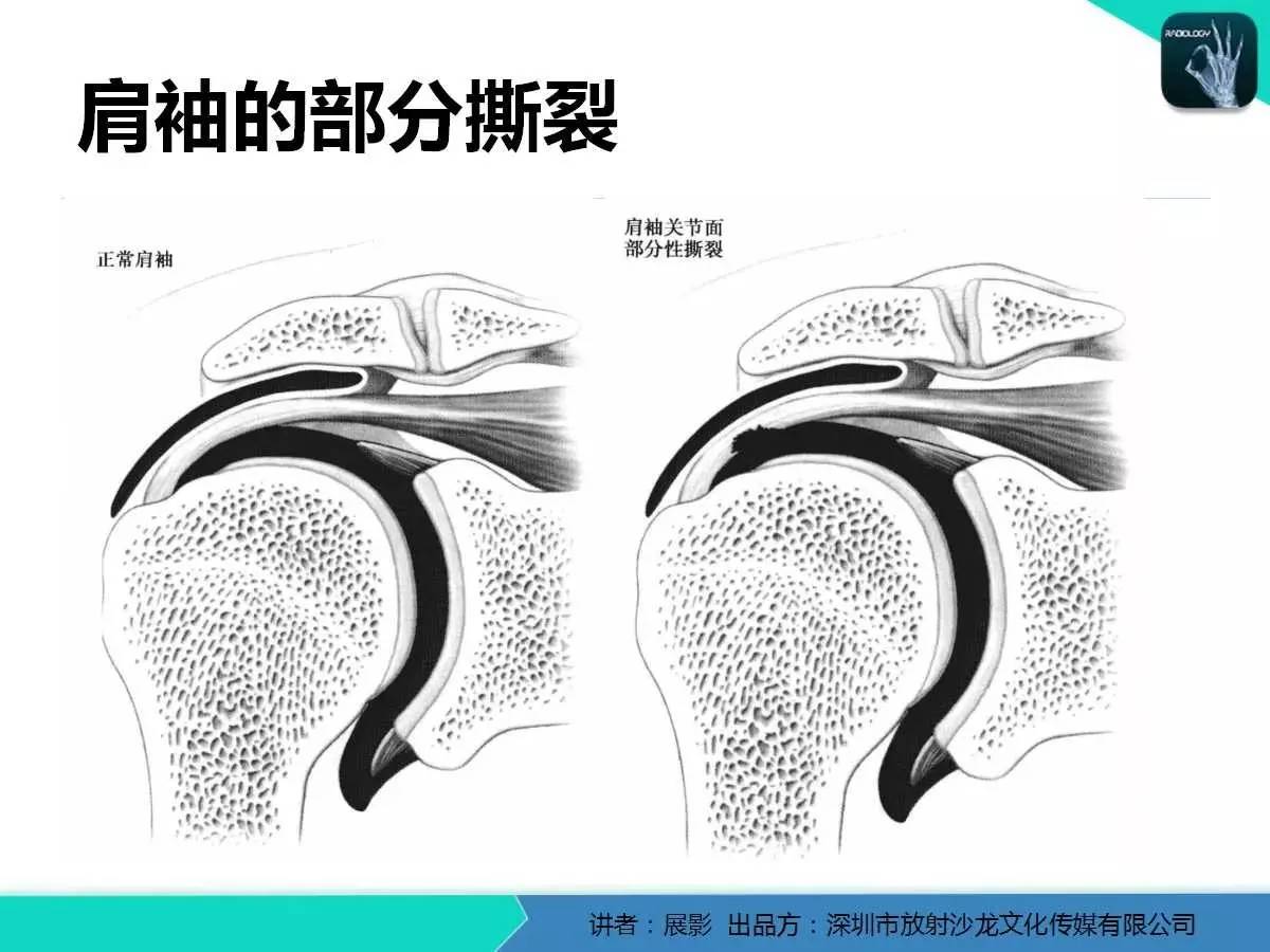 肩峰下撞击综合征和肩袖损伤的MR表现