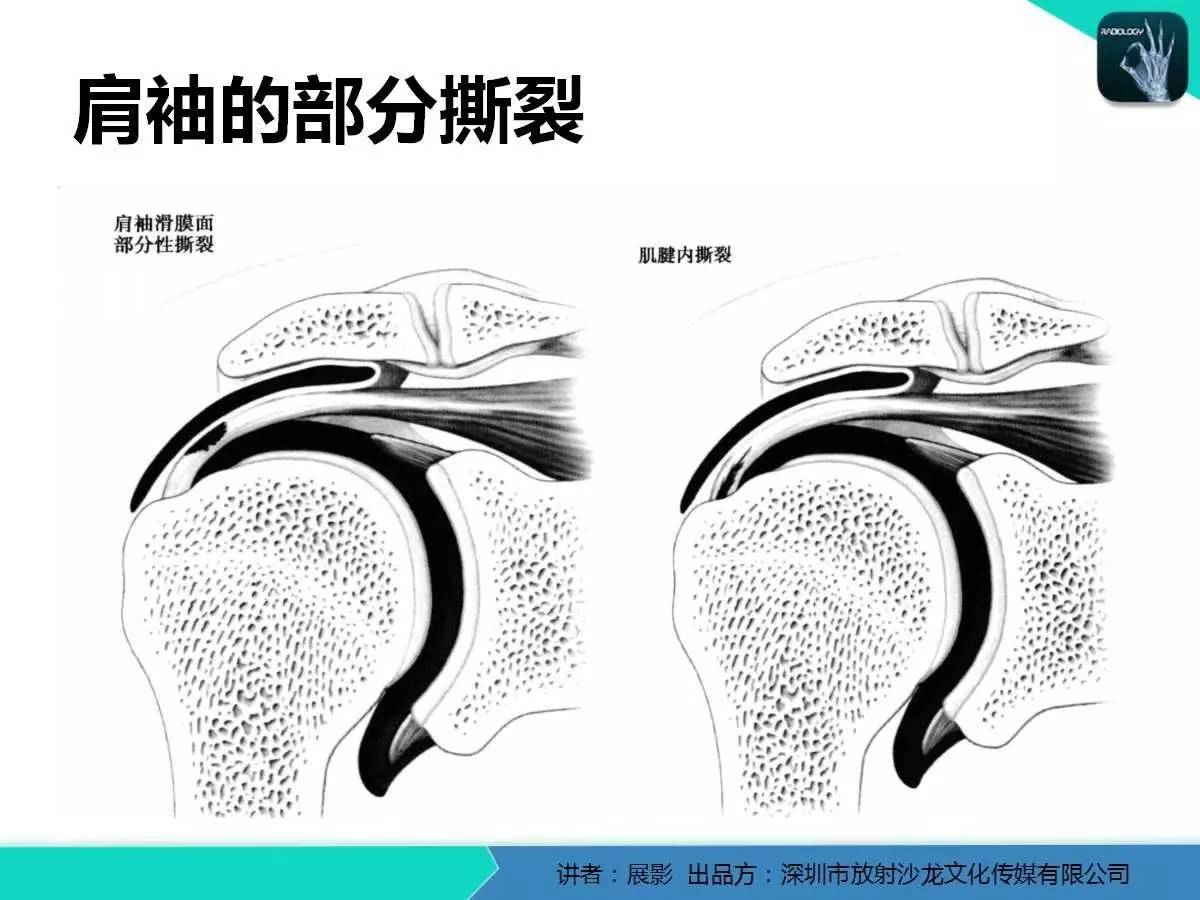 肩峰下撞击综合征和肩袖损伤的MR表现