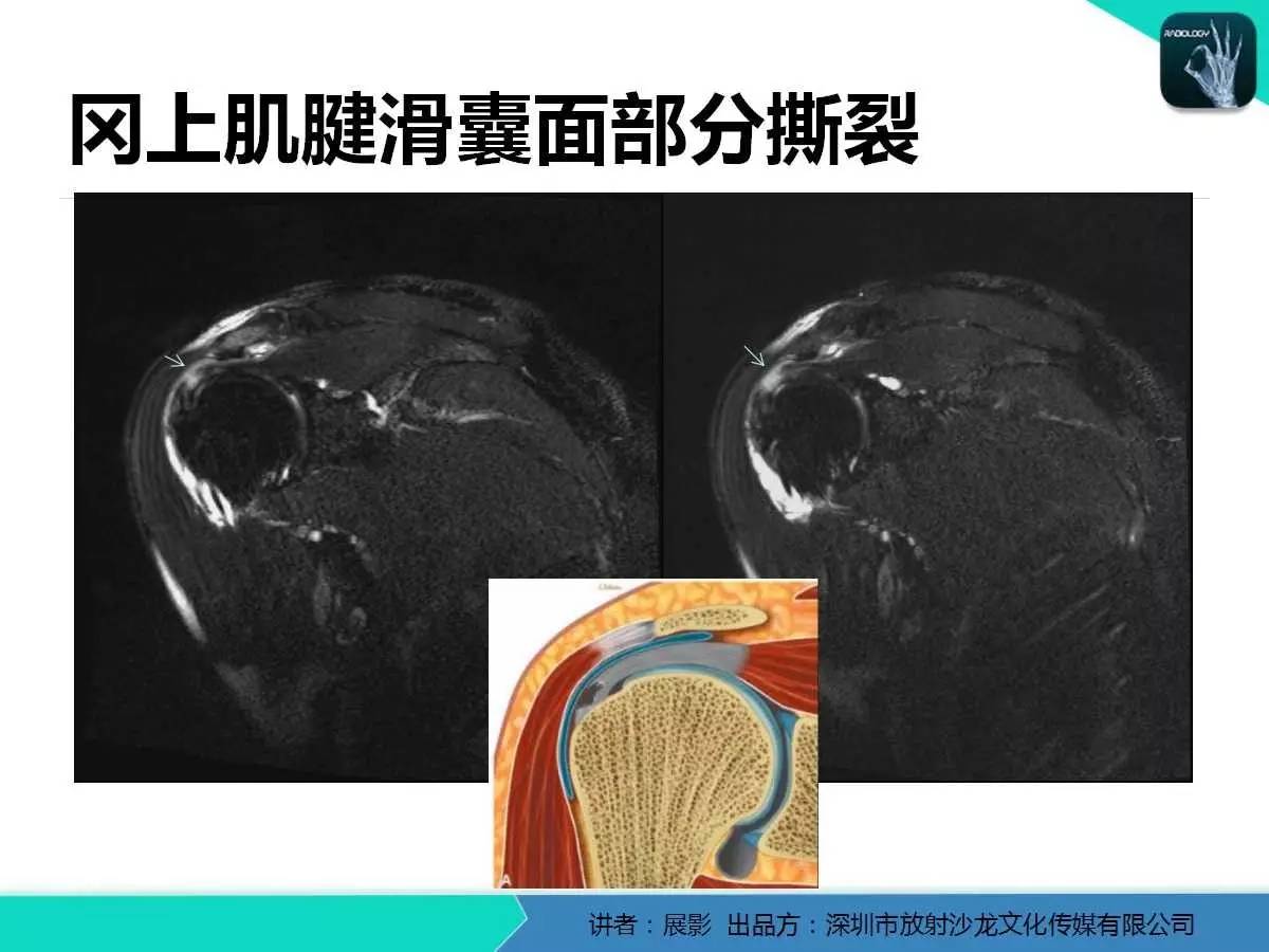 肩峰下撞击综合征和肩袖损伤的MR表现