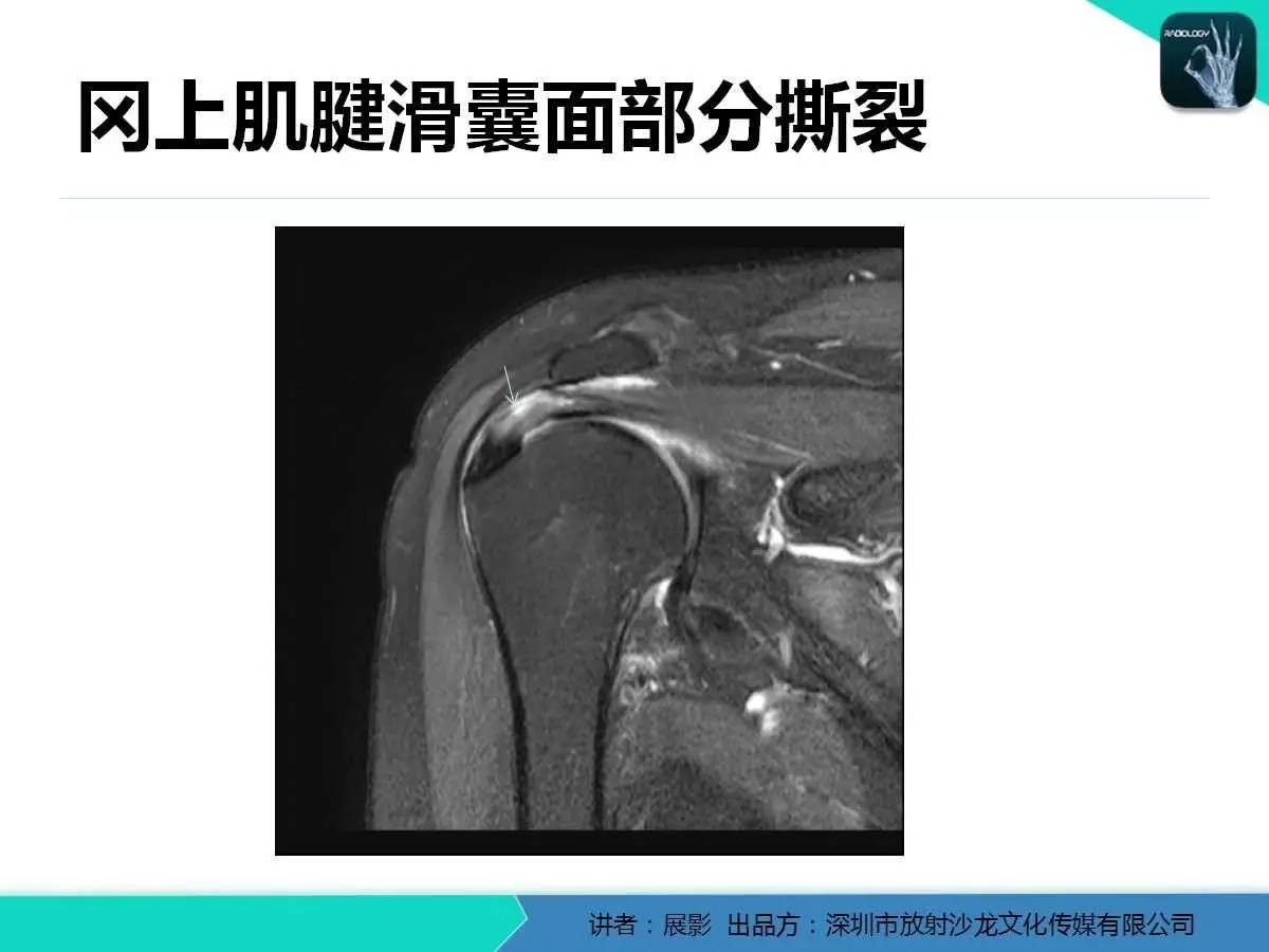 肩峰下撞击综合征和肩袖损伤的MR表现