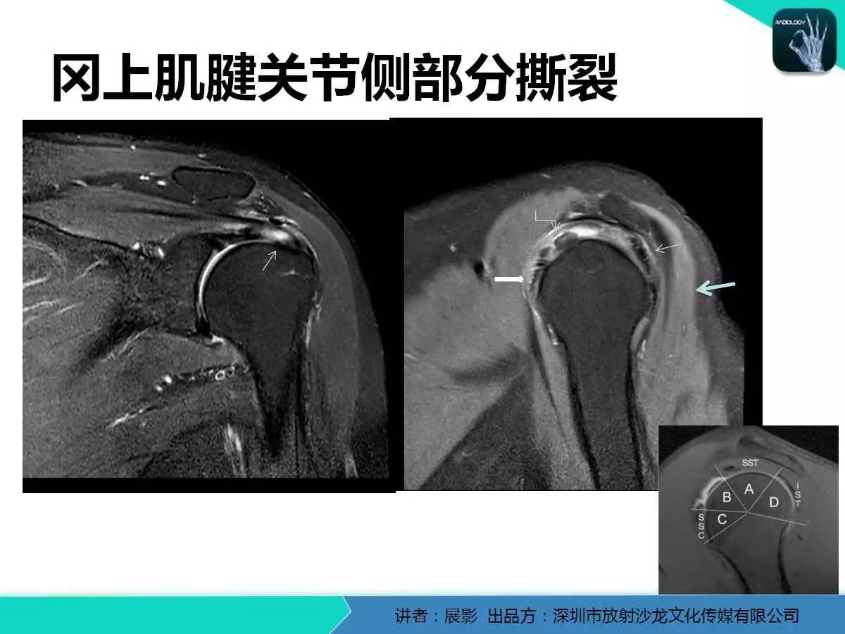 肩峰下撞击综合征和肩袖损伤的MR表现