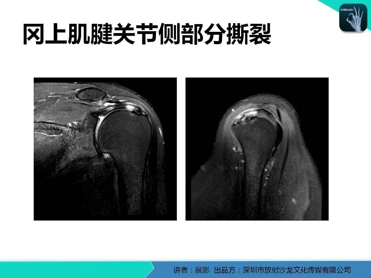 肩峰下撞击综合征和肩袖损伤的MR表现