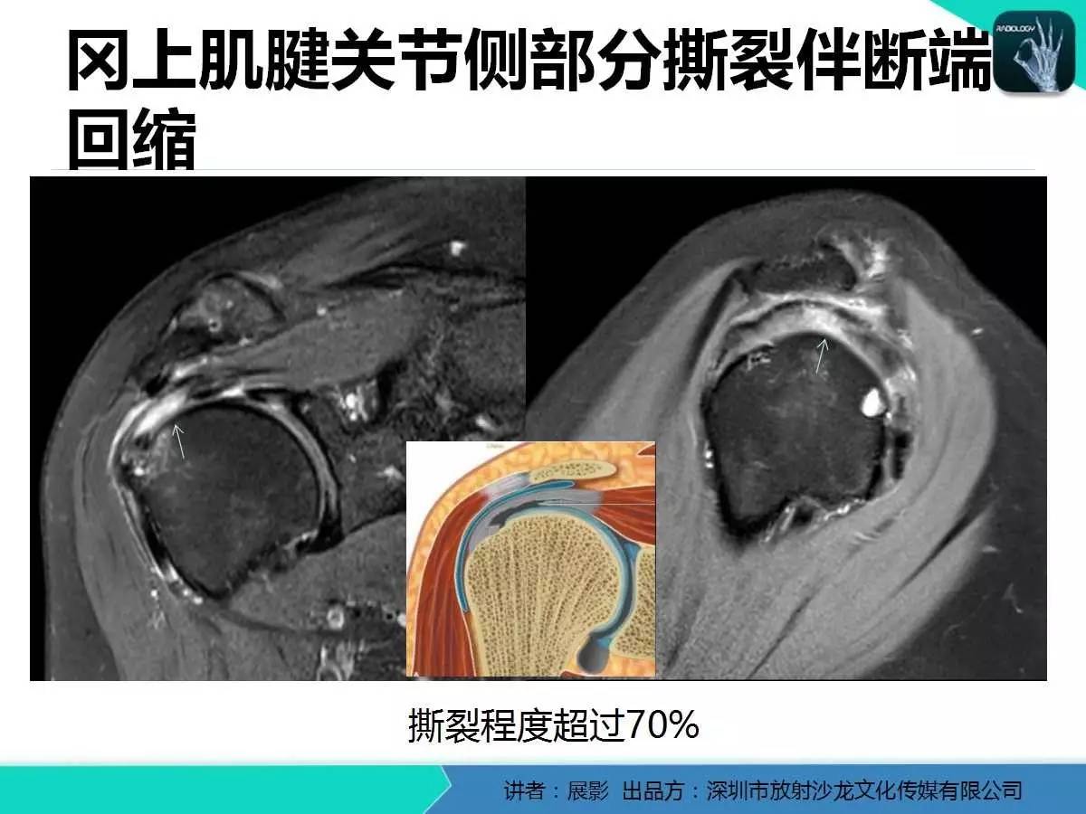 肩峰下撞击综合征和肩袖损伤的MR表现