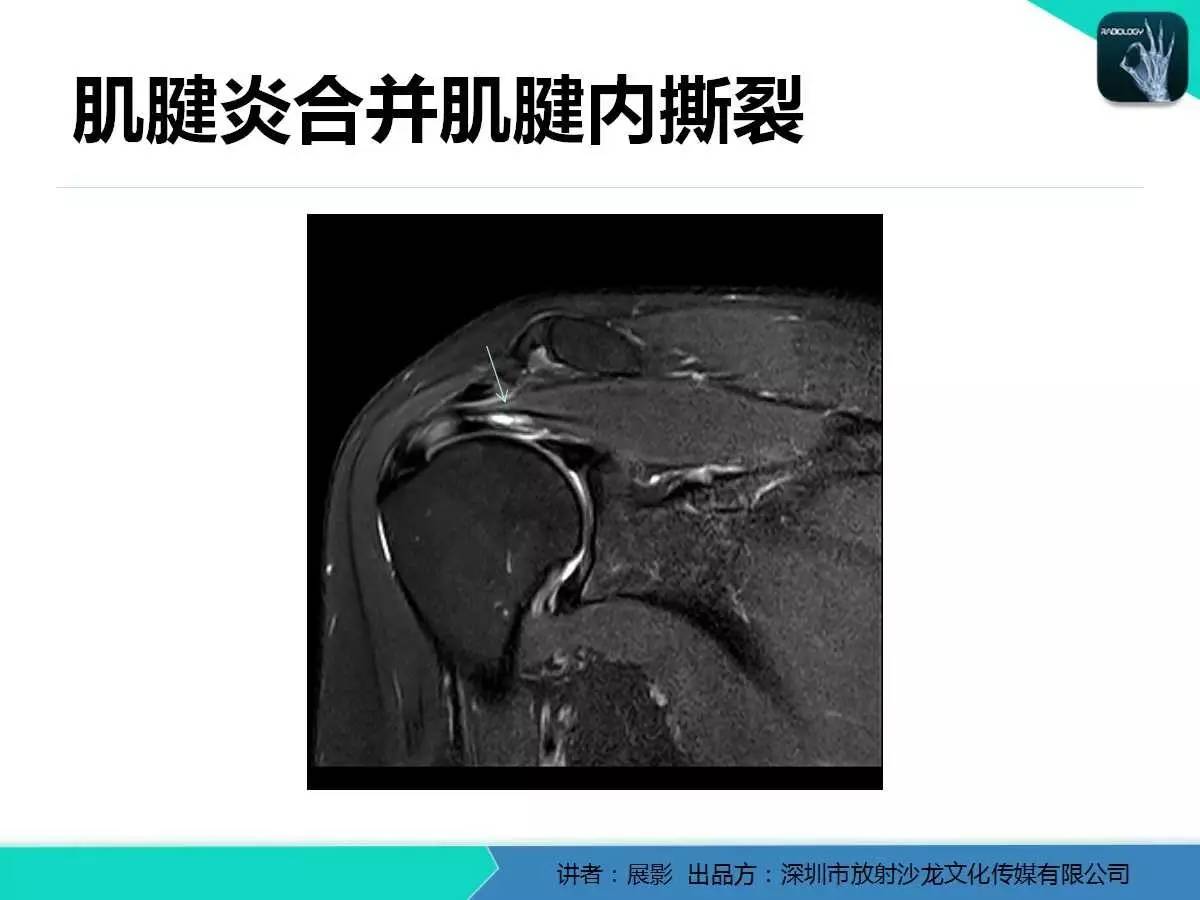 肩峰下撞击综合征和肩袖损伤的MR表现