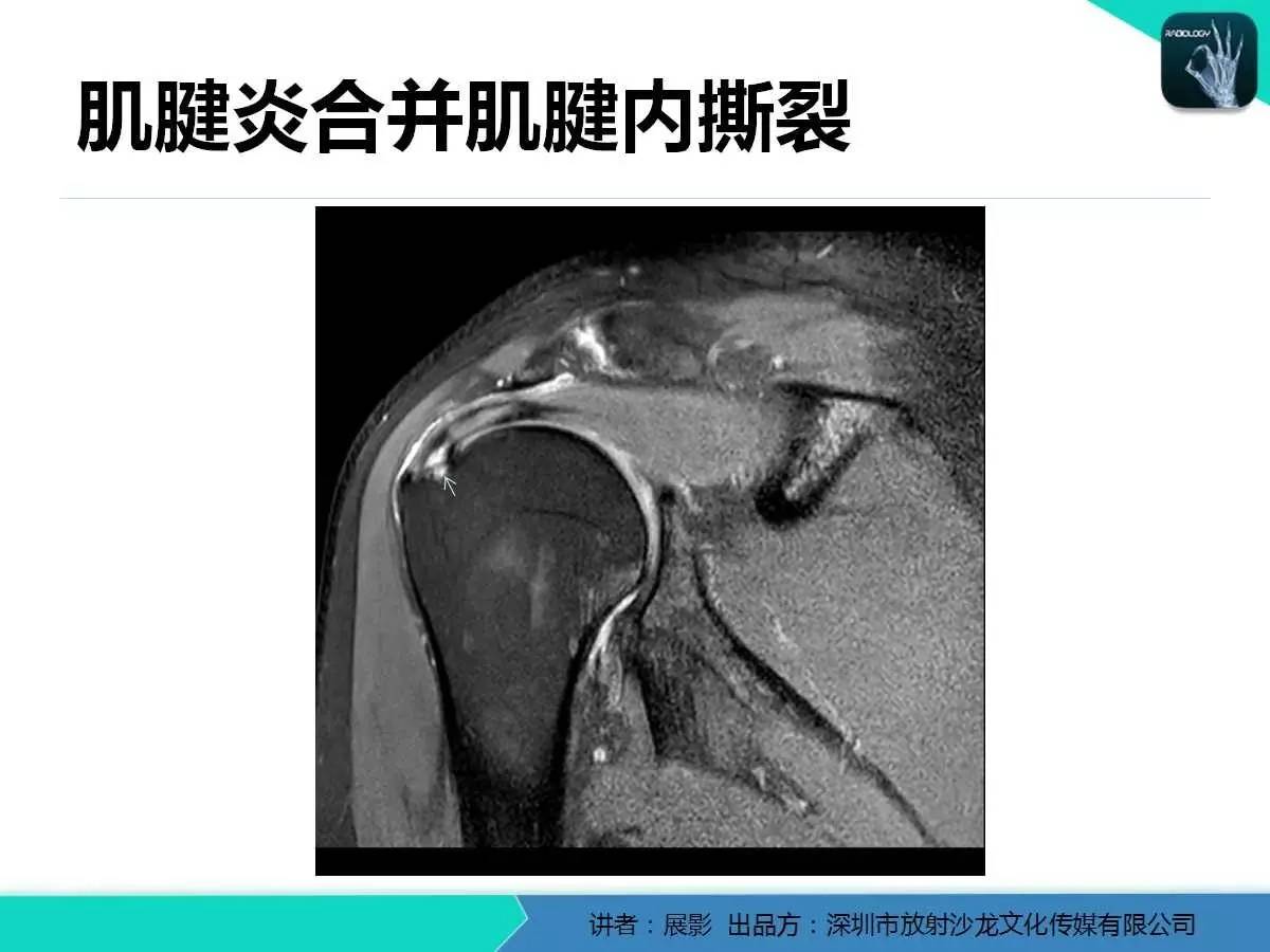 肩峰下撞击综合征和肩袖损伤的MR表现