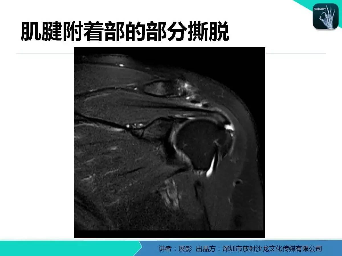 肩峰下撞击综合征和肩袖损伤的MR表现