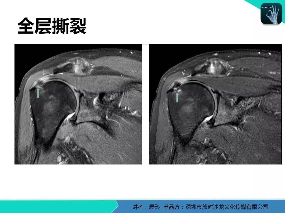 肩峰下撞击综合征和肩袖损伤的MR表现