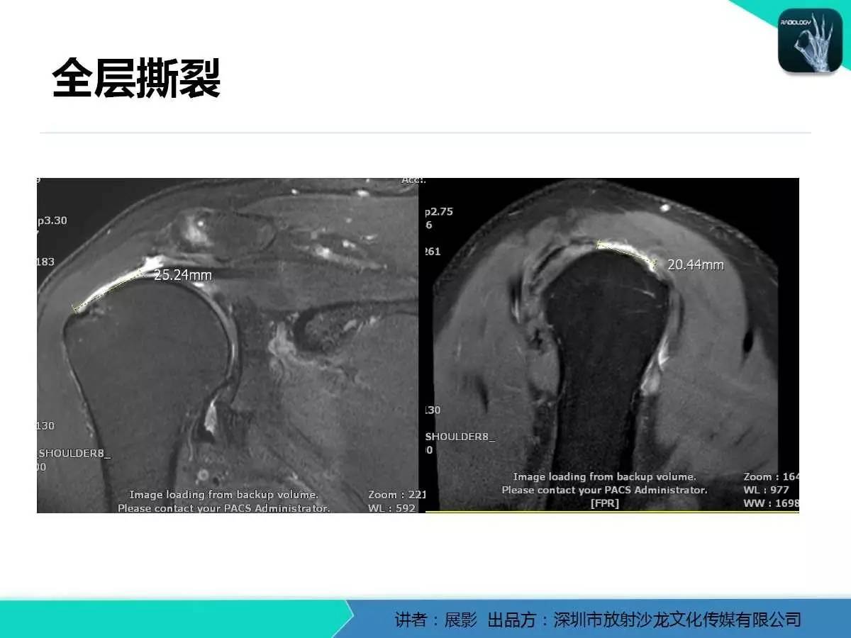 肩峰下撞击综合征和肩袖损伤的MR表现