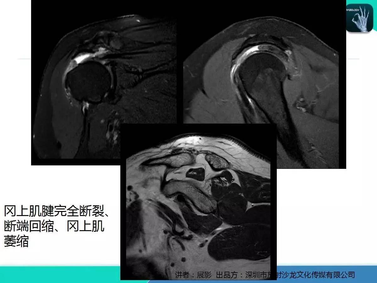 肩峰下撞击综合征和肩袖损伤的MR表现