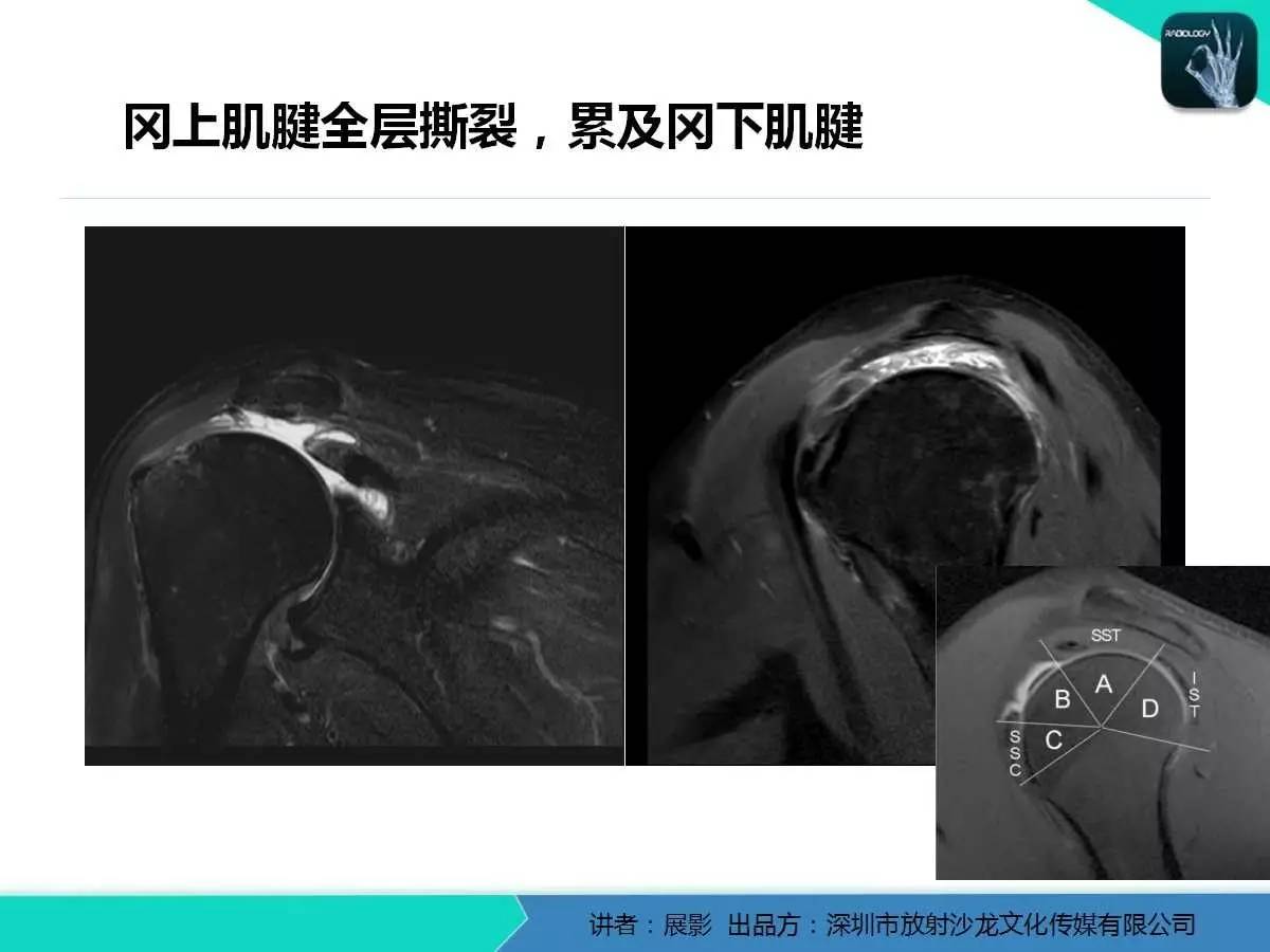 肩峰下撞击综合征和肩袖损伤的MR表现