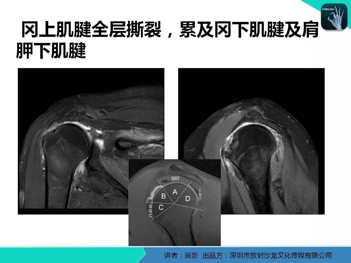 肩峰下撞击综合征和肩袖损伤的MR表现