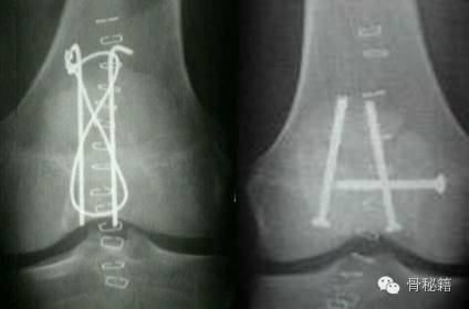 髌骨骨折的常见问题及手术技巧