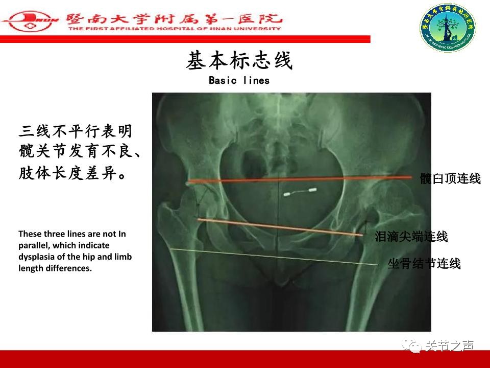 全髋关节置换的X线评估