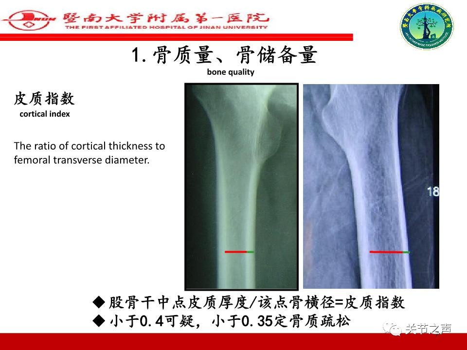 全髋关节置换的X线评估