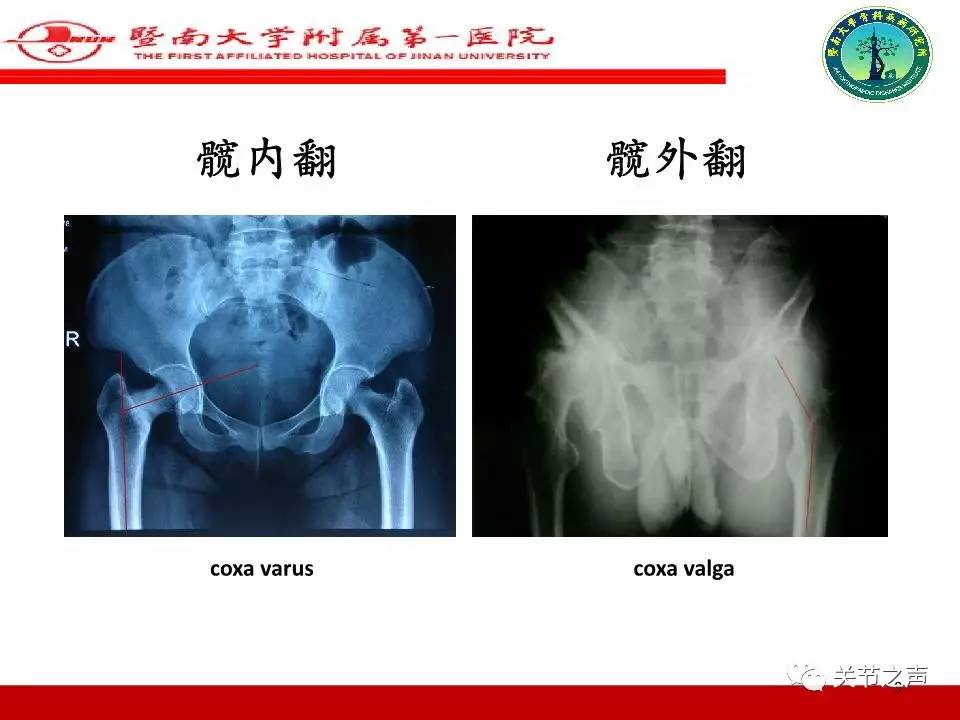 全髋关节置换的X线评估