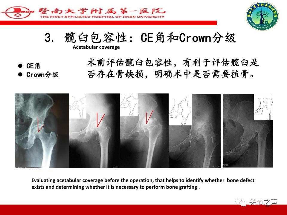 全髋关节置换的X线评估