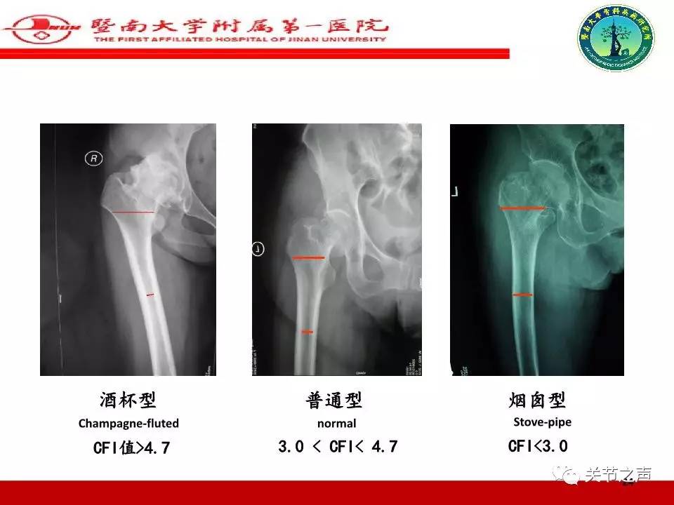 全髋关节置换的X线评估