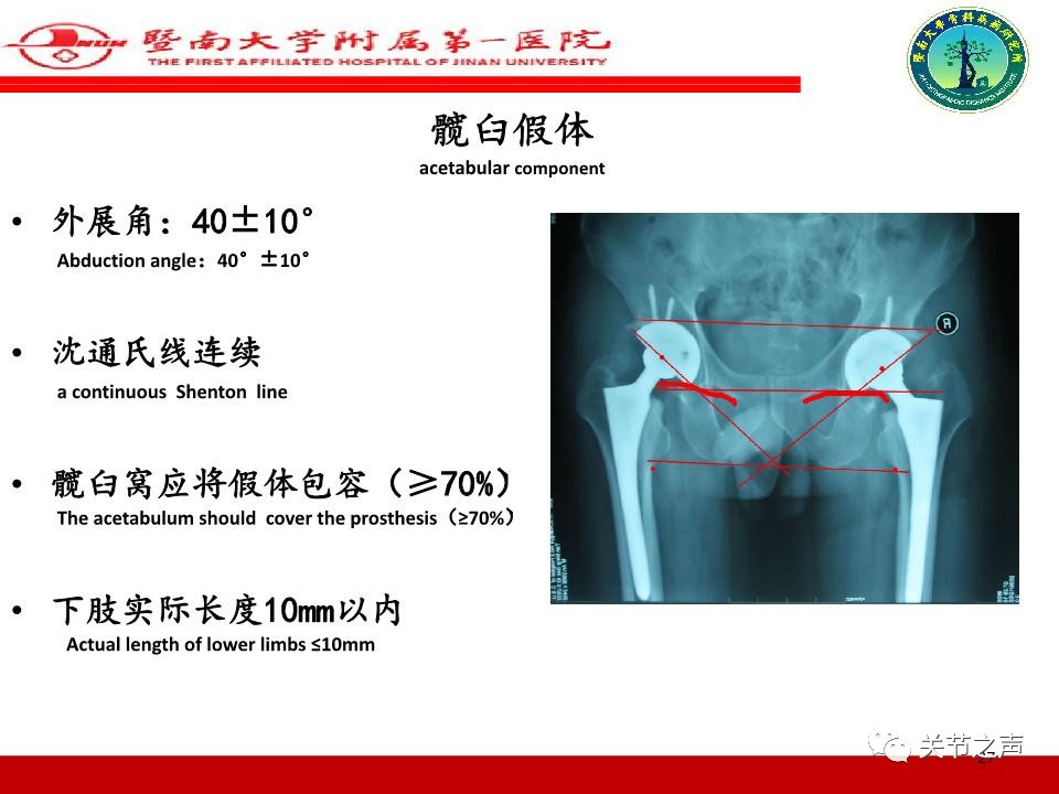 全髋关节置换的X线评估