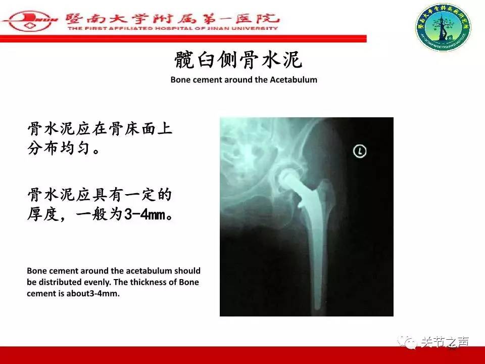 全髋关节置换的X线评估