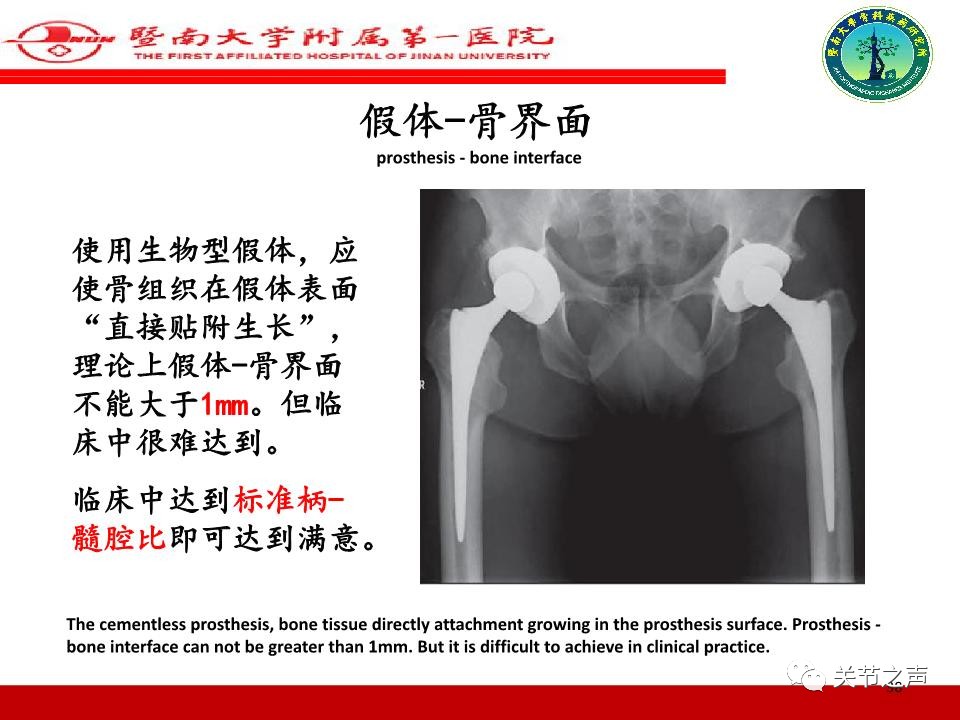 全髋关节置换的X线评估