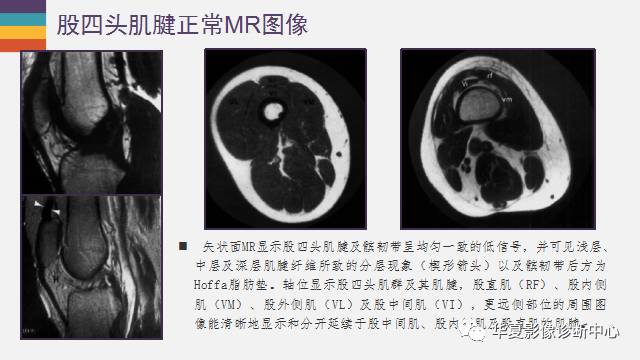 膝关节周围的那些肌腱你都认识吗？