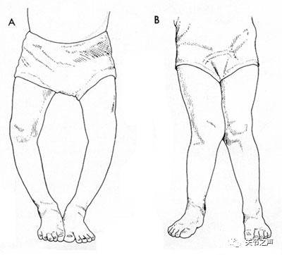 评估膝关节疾病-双下肢全长负重位X线