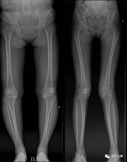 评估膝关节疾病-双下肢全长负重位X线