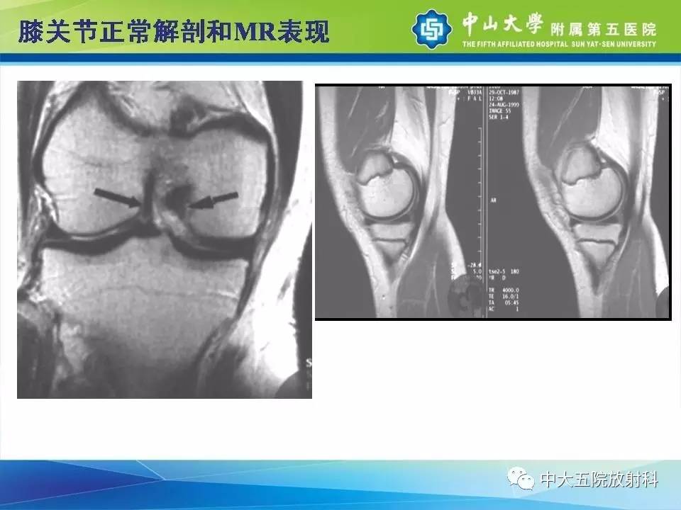 膝关节半月板和韧带损伤的影像学诊断