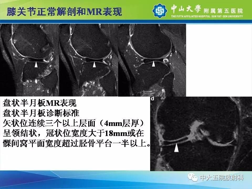 膝关节半月板和韧带损伤的影像学诊断