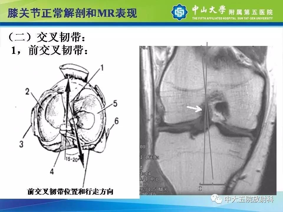 膝关节半月板和韧带损伤的影像学诊断