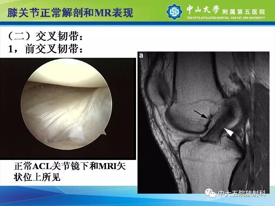 膝关节半月板和韧带损伤的影像学诊断