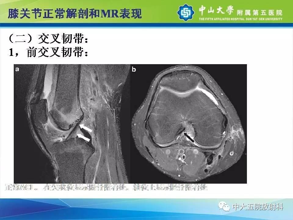 膝关节半月板和韧带损伤的影像学诊断