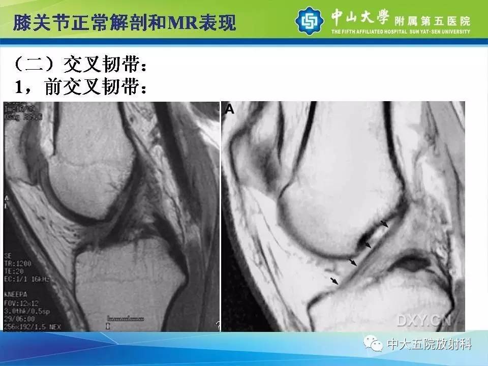 膝关节半月板和韧带损伤的影像学诊断