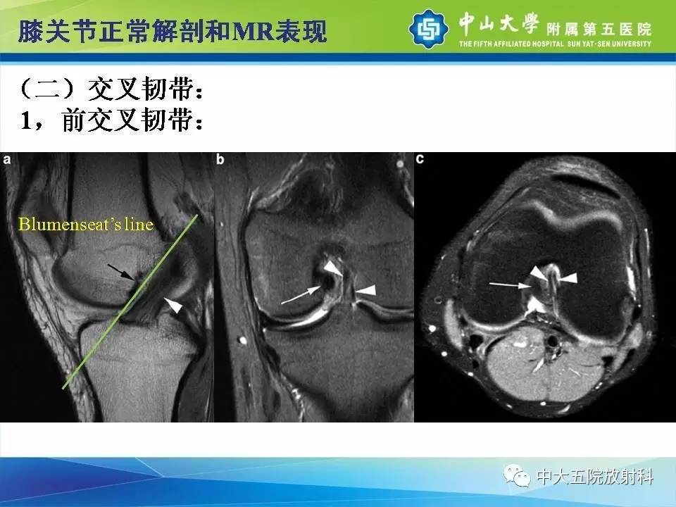 膝关节半月板和韧带损伤的影像学诊断