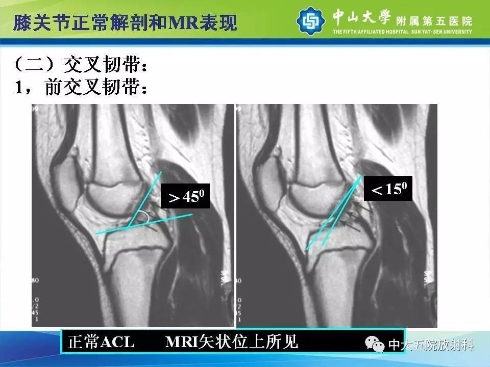 膝关节半月板和韧带损伤的影像学诊断