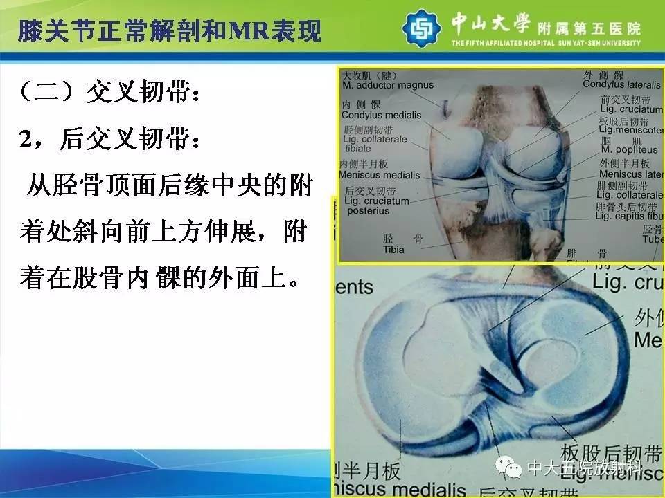 膝关节半月板和韧带损伤的影像学诊断