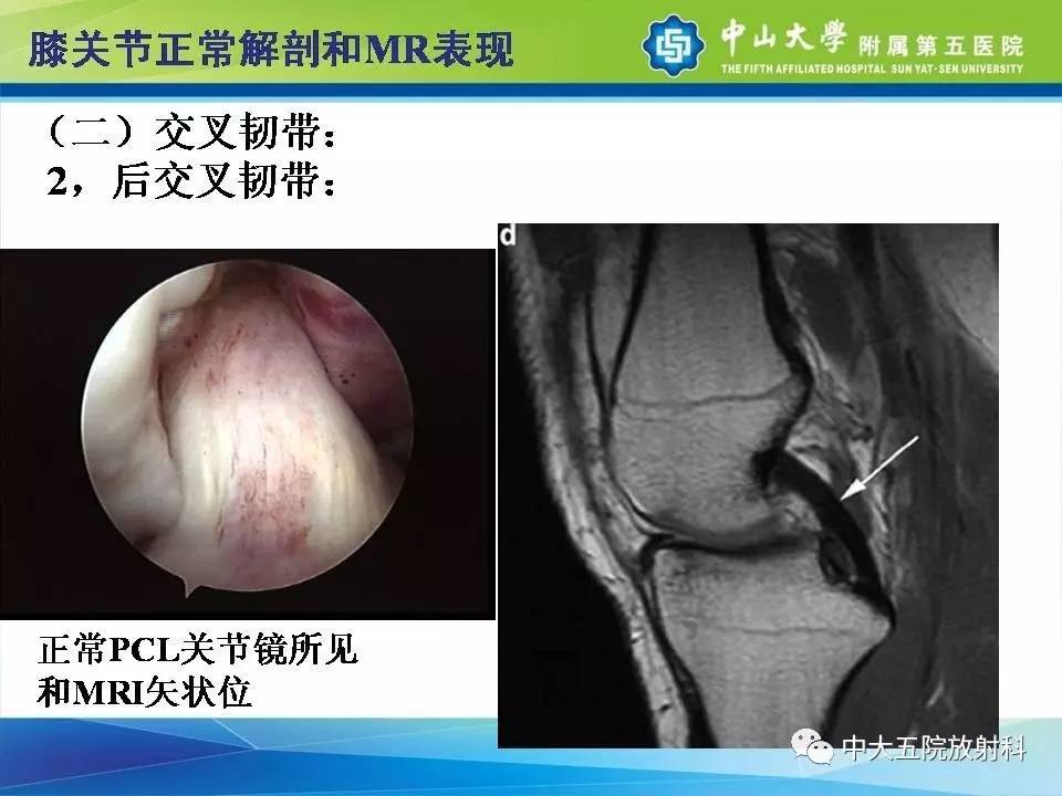 膝关节半月板和韧带损伤的影像学诊断